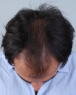 Before Hair Transplant&nbsp;Front